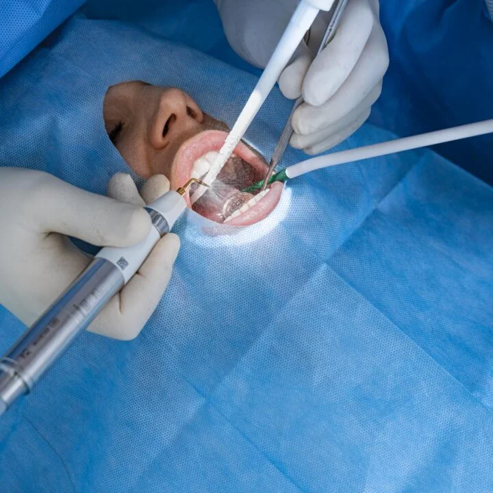 Podniesienie dna zatoki szczękowej przed wszczepieniem implantów